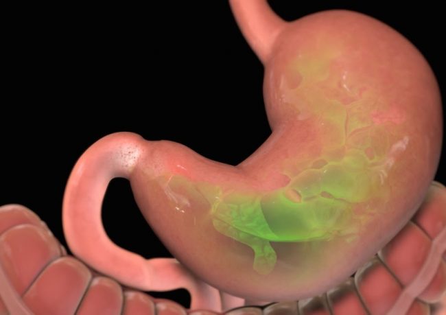 ulcer-gastro-duodenal