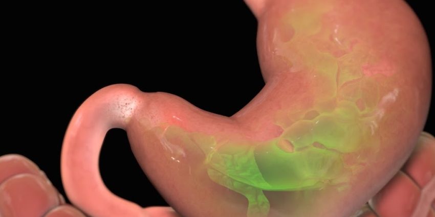 ulcer-gastro-duodenal