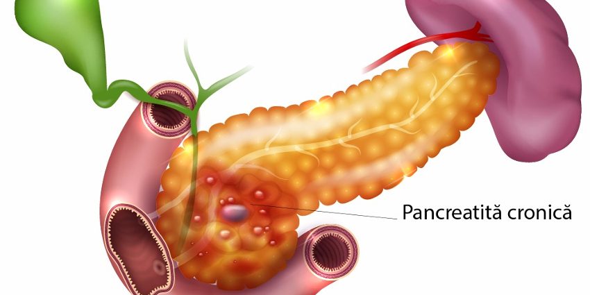 pancreatita-cronica