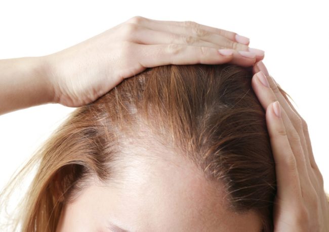 alopecie