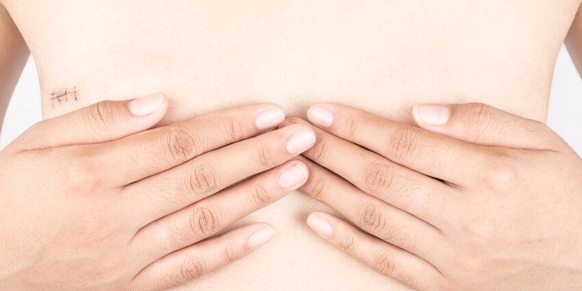 Scars,From,Surgery,Breast